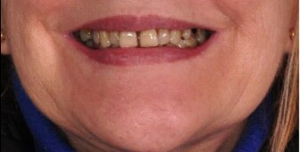 Antes implantes y carillas